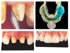How will my Dentist fit a Royale Crown?